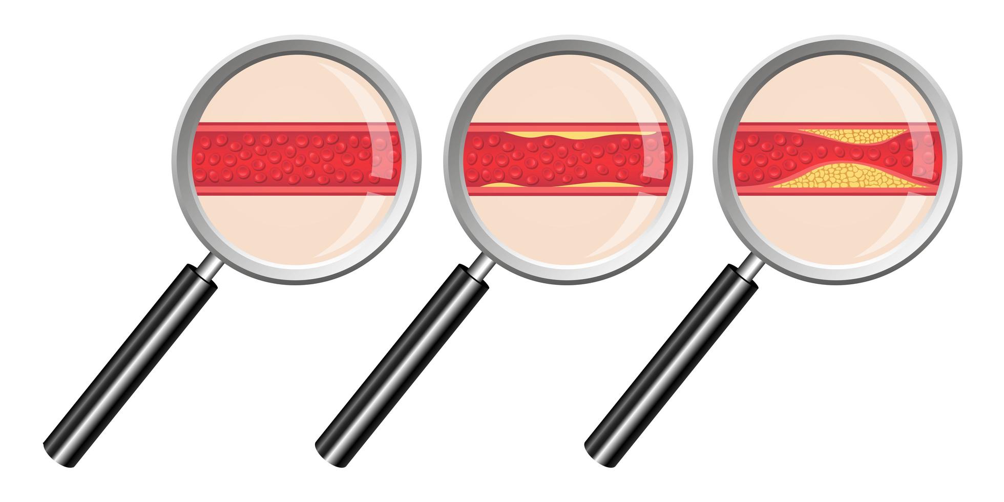 arteriosclerosis aislado sobre fondo blanco vector