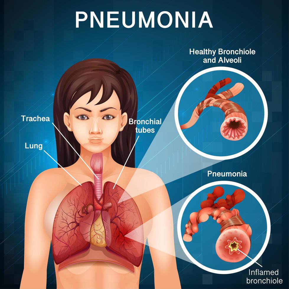 Poster detailing condition of  pneumonia with human lungs vector