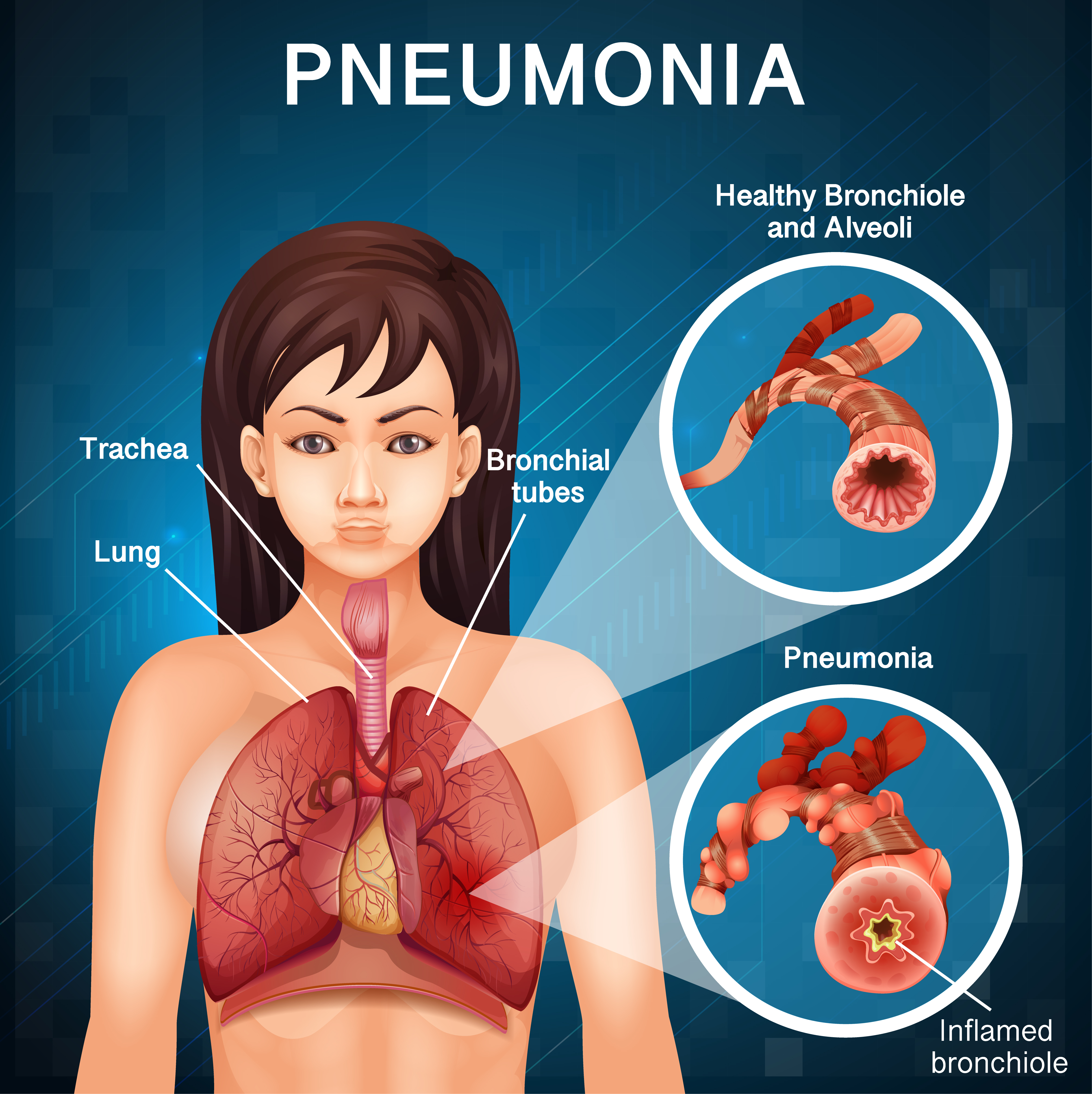 Poster For Pneumonia With Human Lungs Vector Art At Vecteezy My Xxx