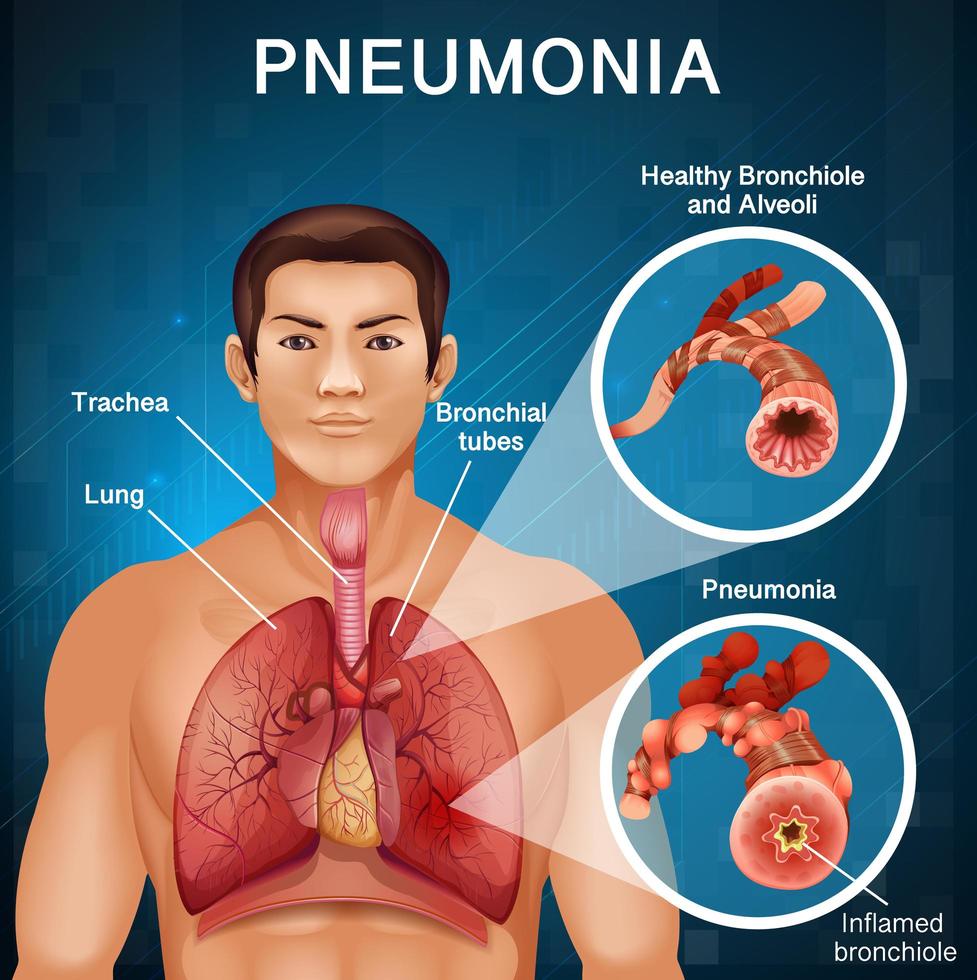 Man with pneumonia with bad lungs in human body vector