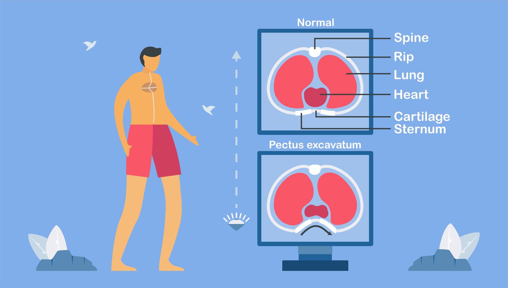 Pectus excavatum is a structural deformity vector