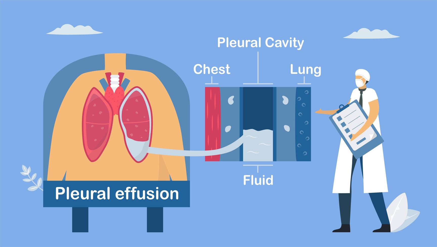 Lung disease about pleural effusion. vector