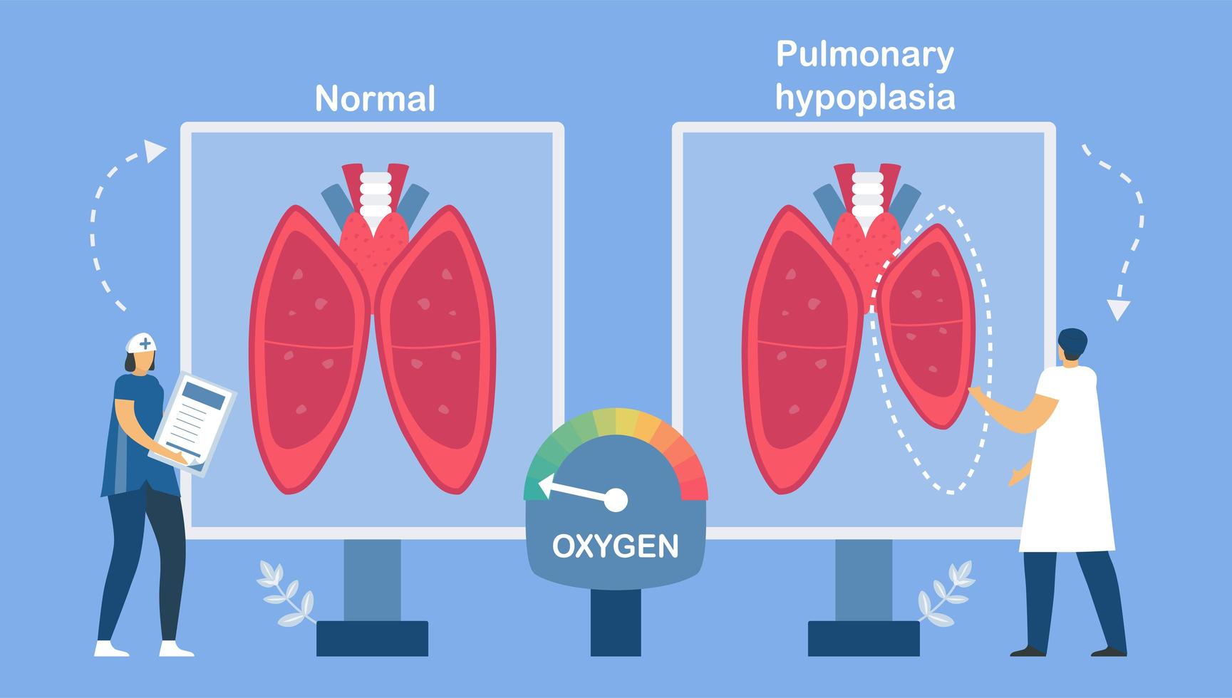 Pulmonary hypoplasia about restrictive lung disease. vector