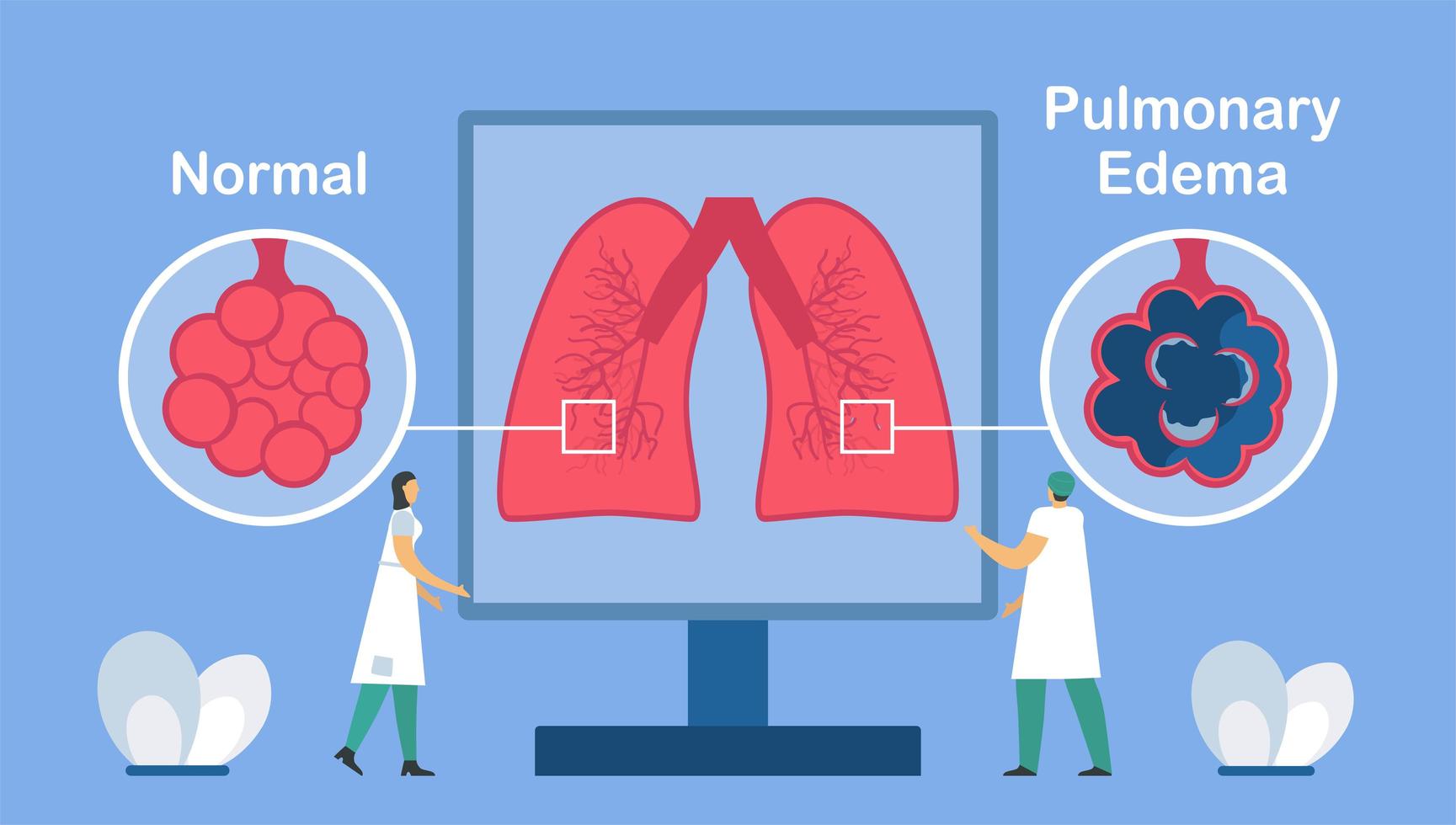 Pulmonary edema is shown good and bad alveoli.  vector