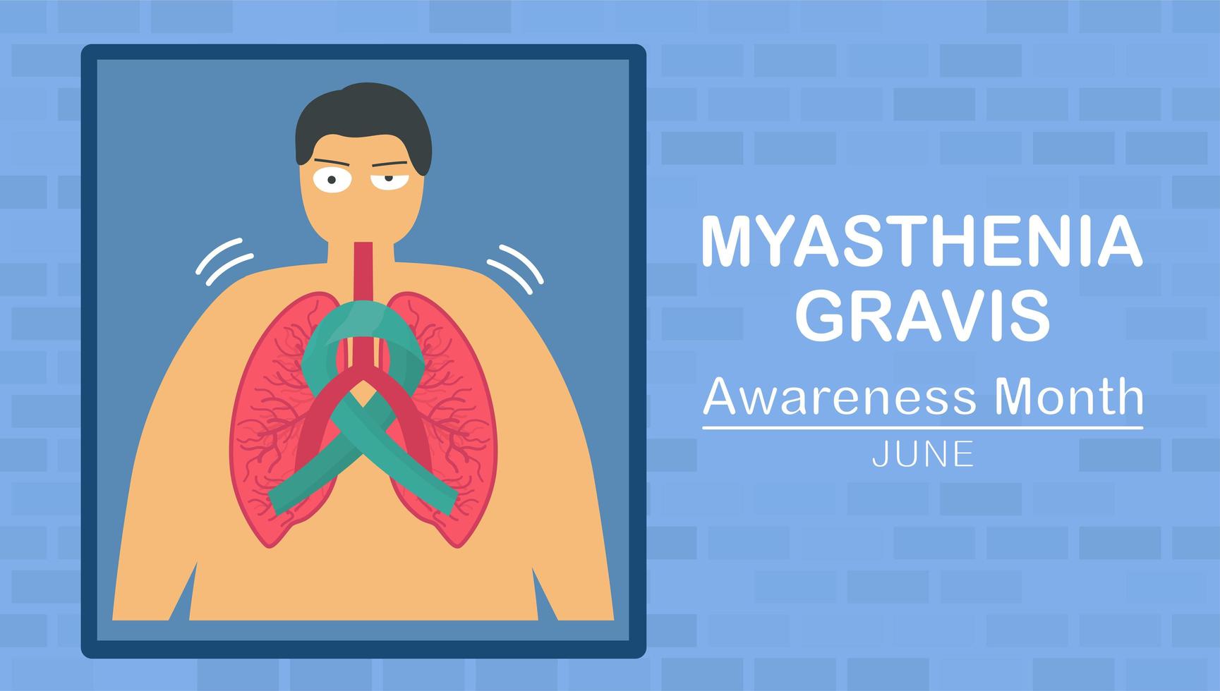 Myasthenia gravis is neuromuscular disease  vector