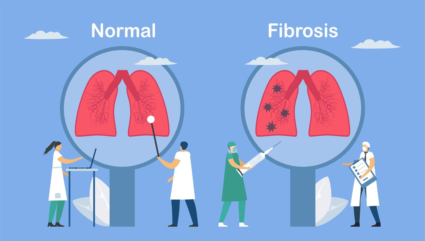 Pulmonary fibrosis is a part of restrictive lung disease vector