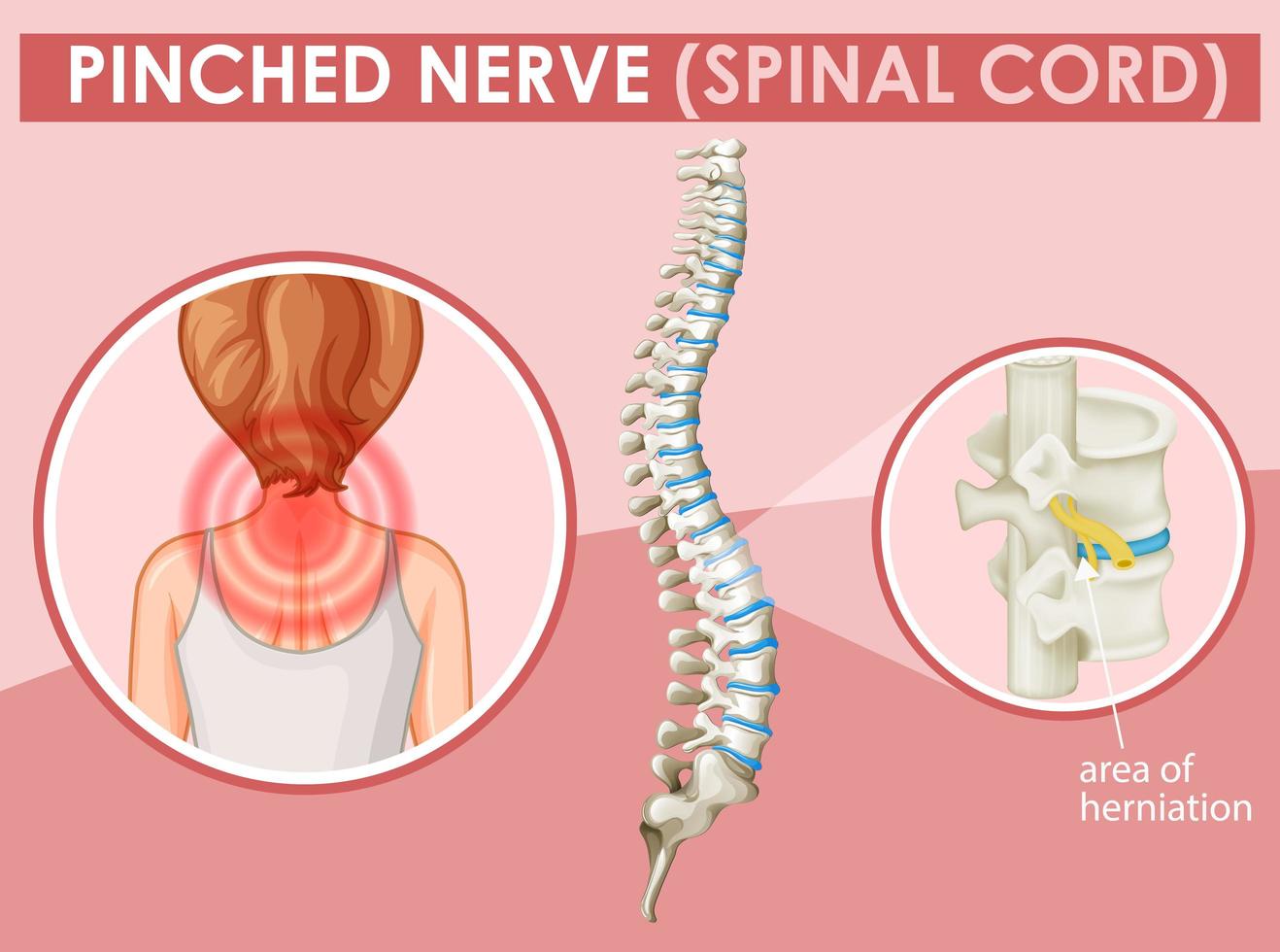 Diagram showing pinched nerve in human vector