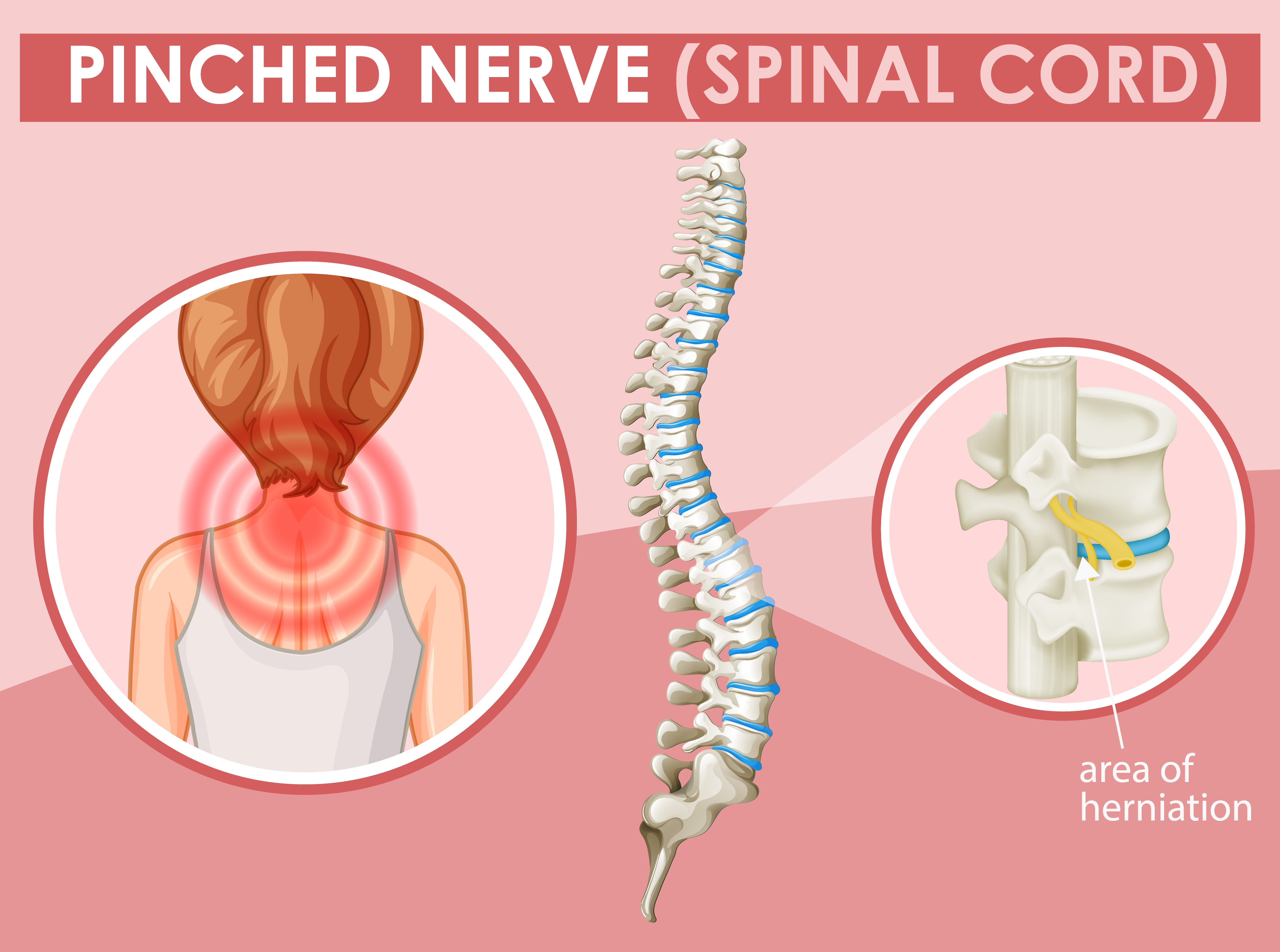 Diagram Showing Pinched Nerve In Human 1235056 Vector Art At Vecteezy