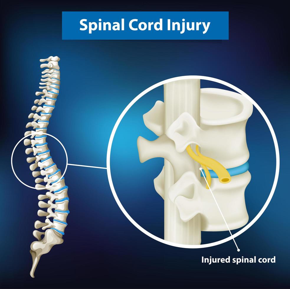 Diagram showing spinal cord injury vector