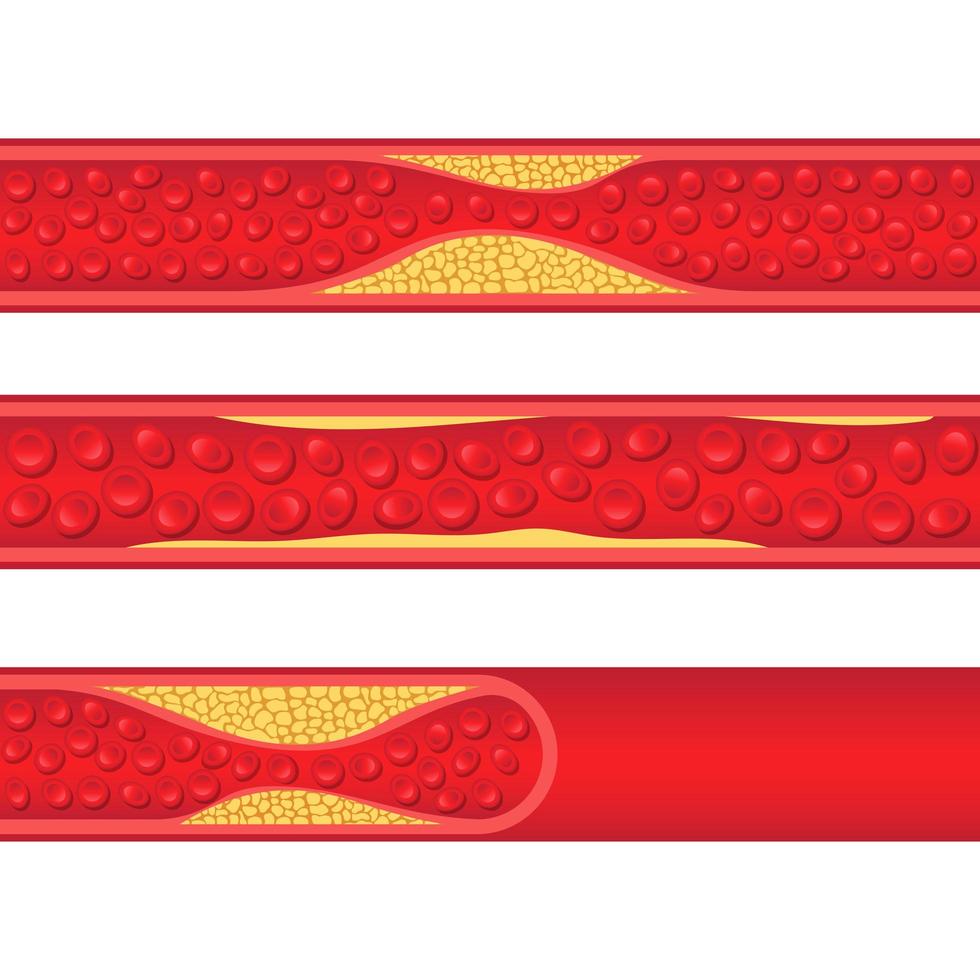 arteriosclerosis aislado en blanco vector