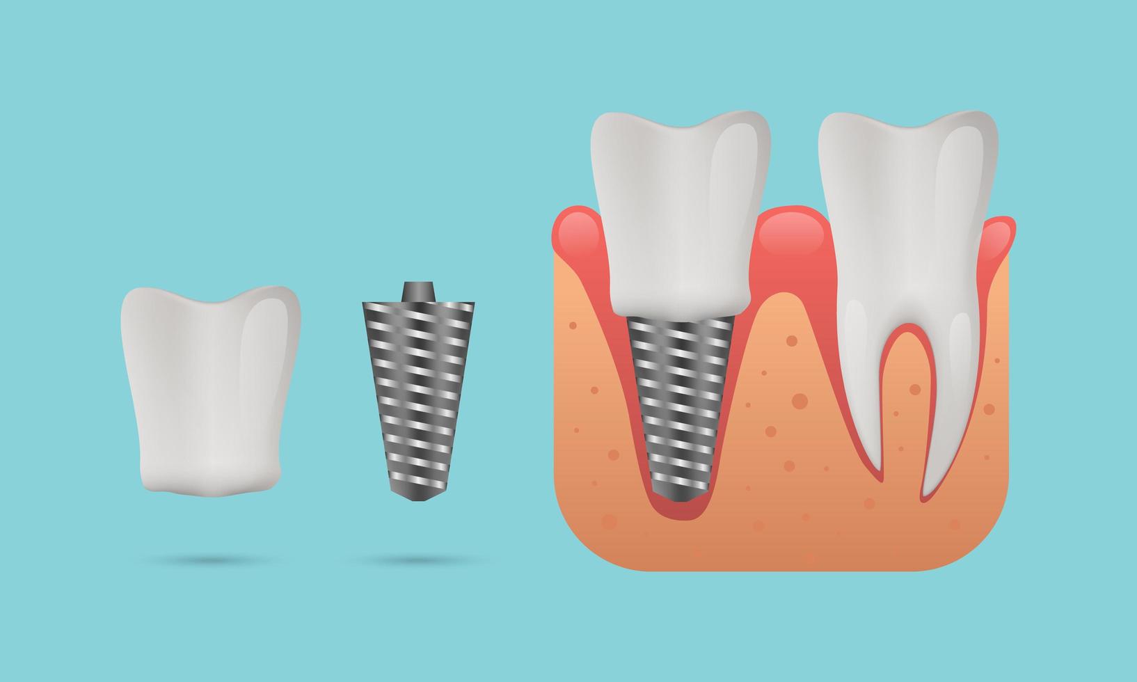 Dental implant structure concept vector