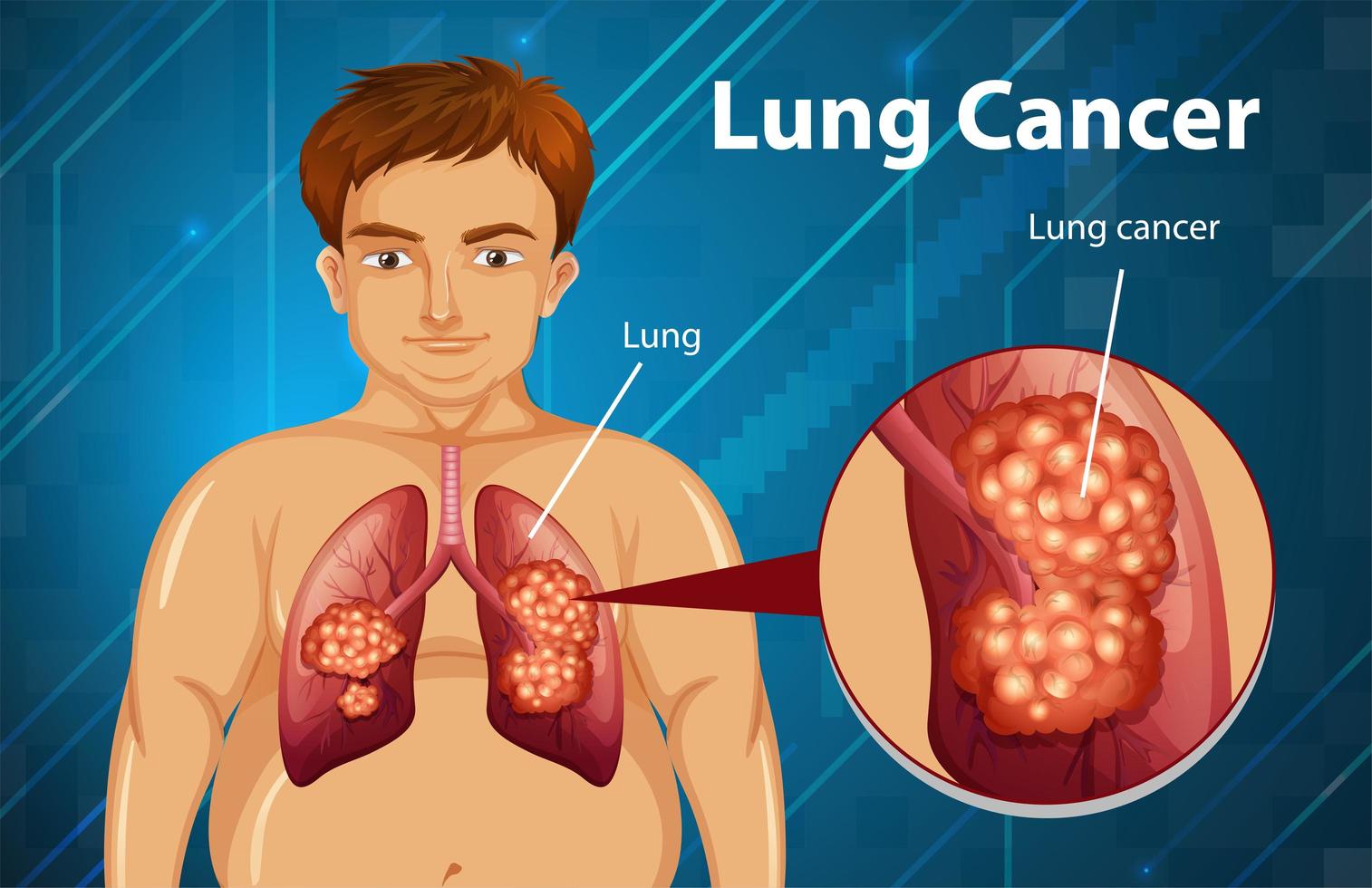 Lung cancer informative design  vector