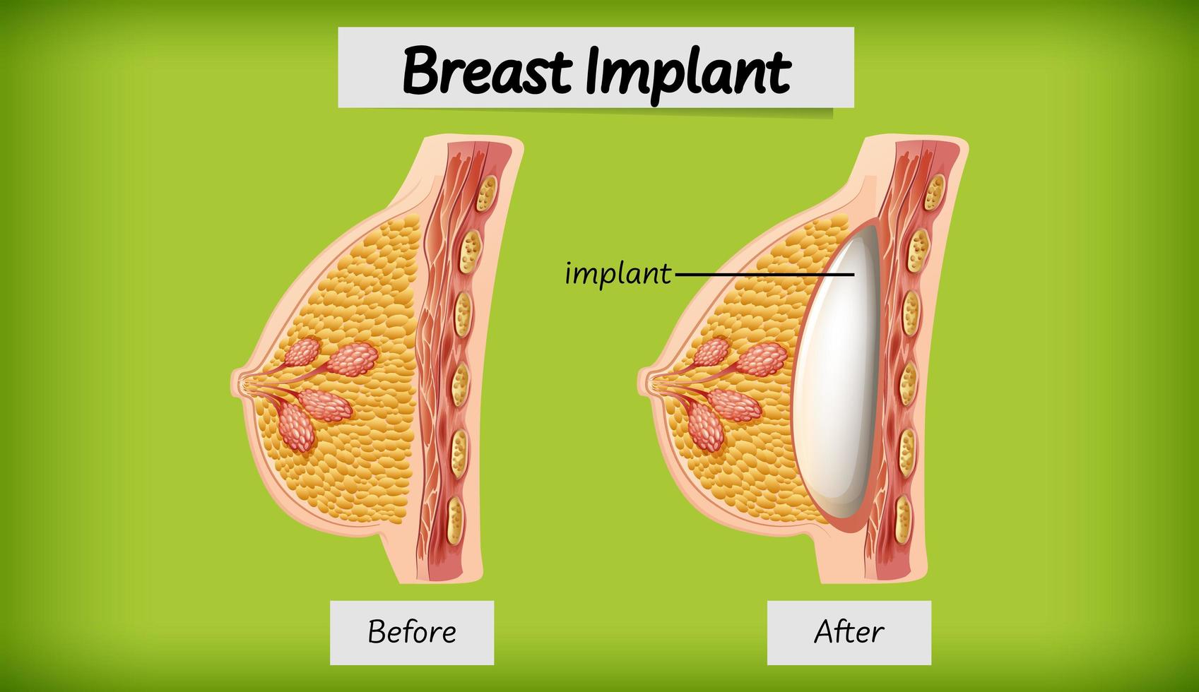 anatomía del implante mamario humano vector