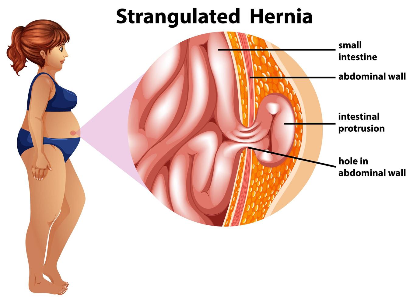 Strangulated hernia diagram vector