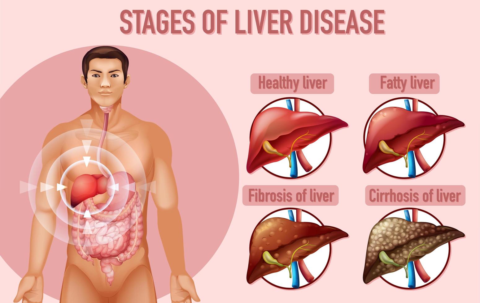 Stages of liver disease educational design  vector