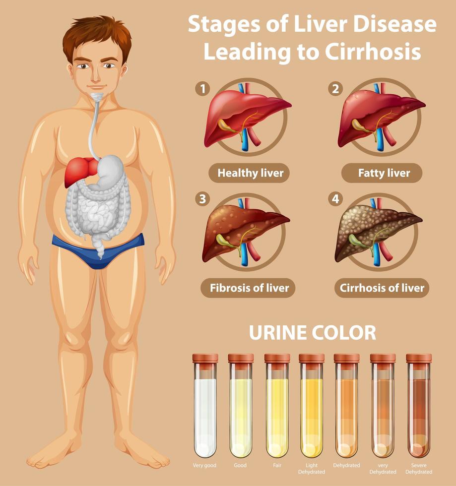 Stages of liver disease educational diagram vector