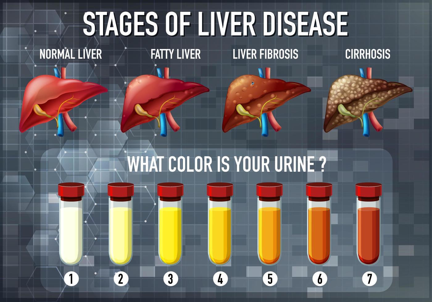 Liver disease educational diagram vector