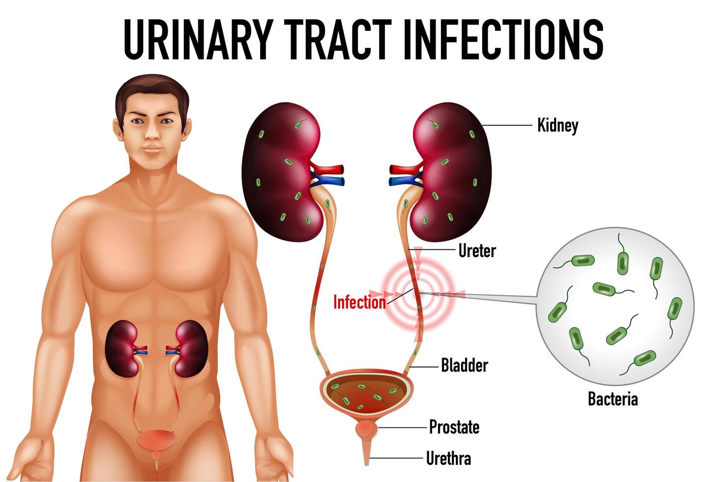 Urinary tract infection educational diagram vector