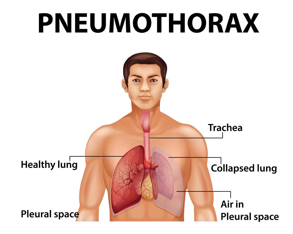 Pneumothorax educational diagram vector