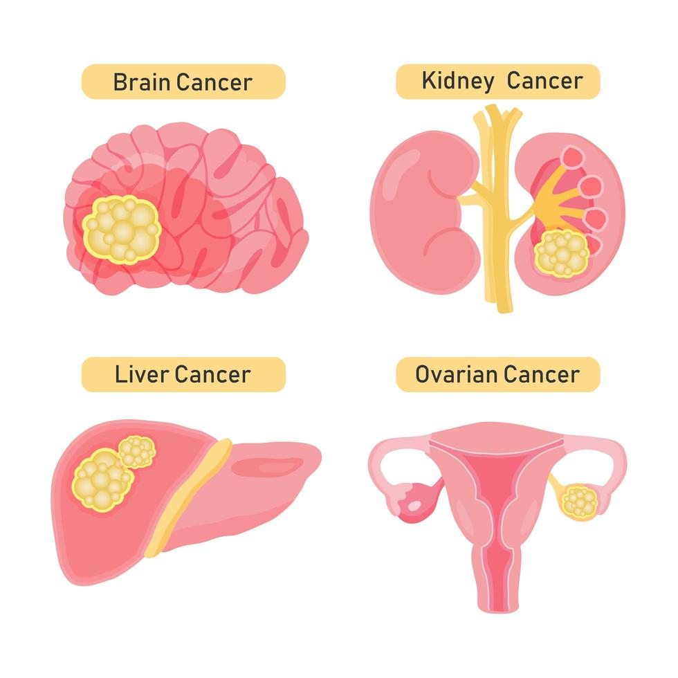 tipos de diseño de cáncer de órgano vector