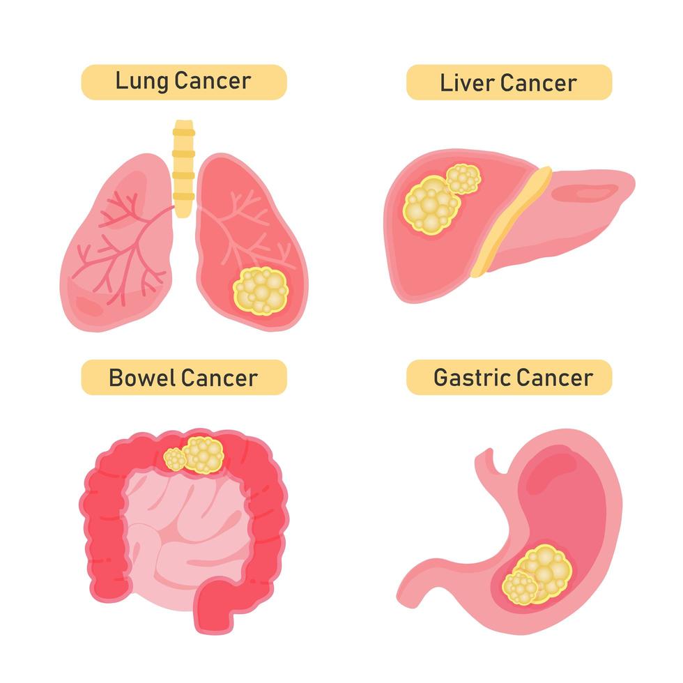 Types of organ cancer design  vector