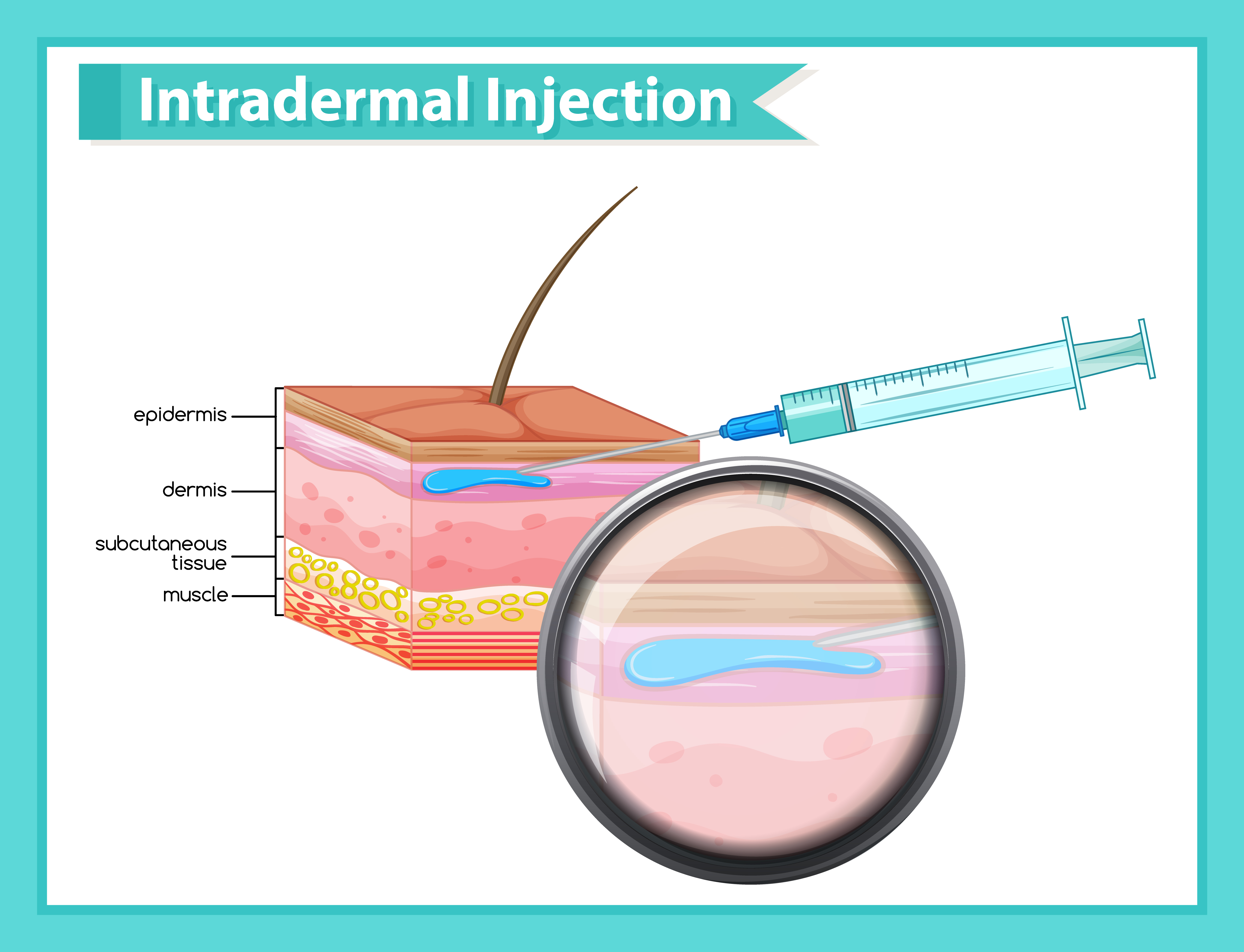 intradermal injection