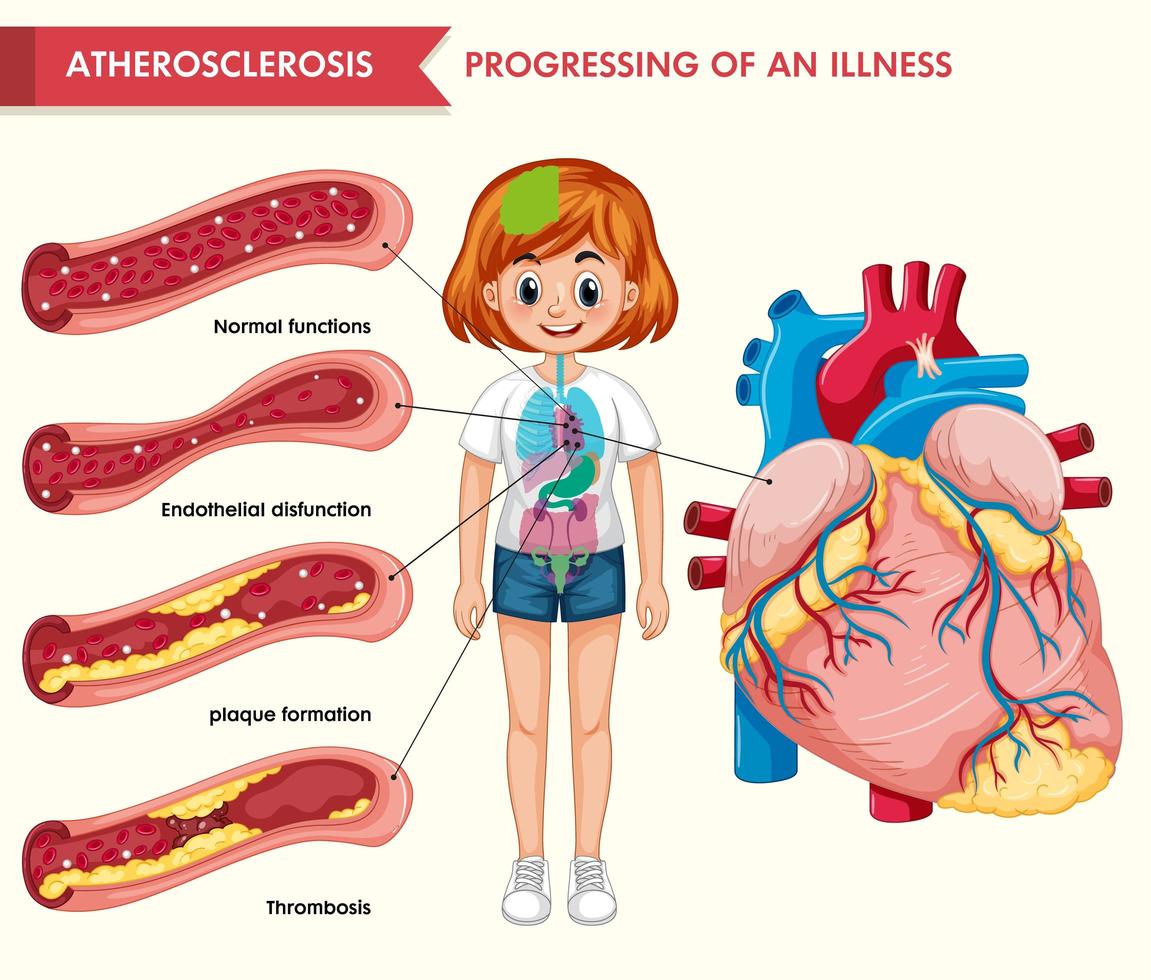Scientific medical illustration of atherosclerosis vector