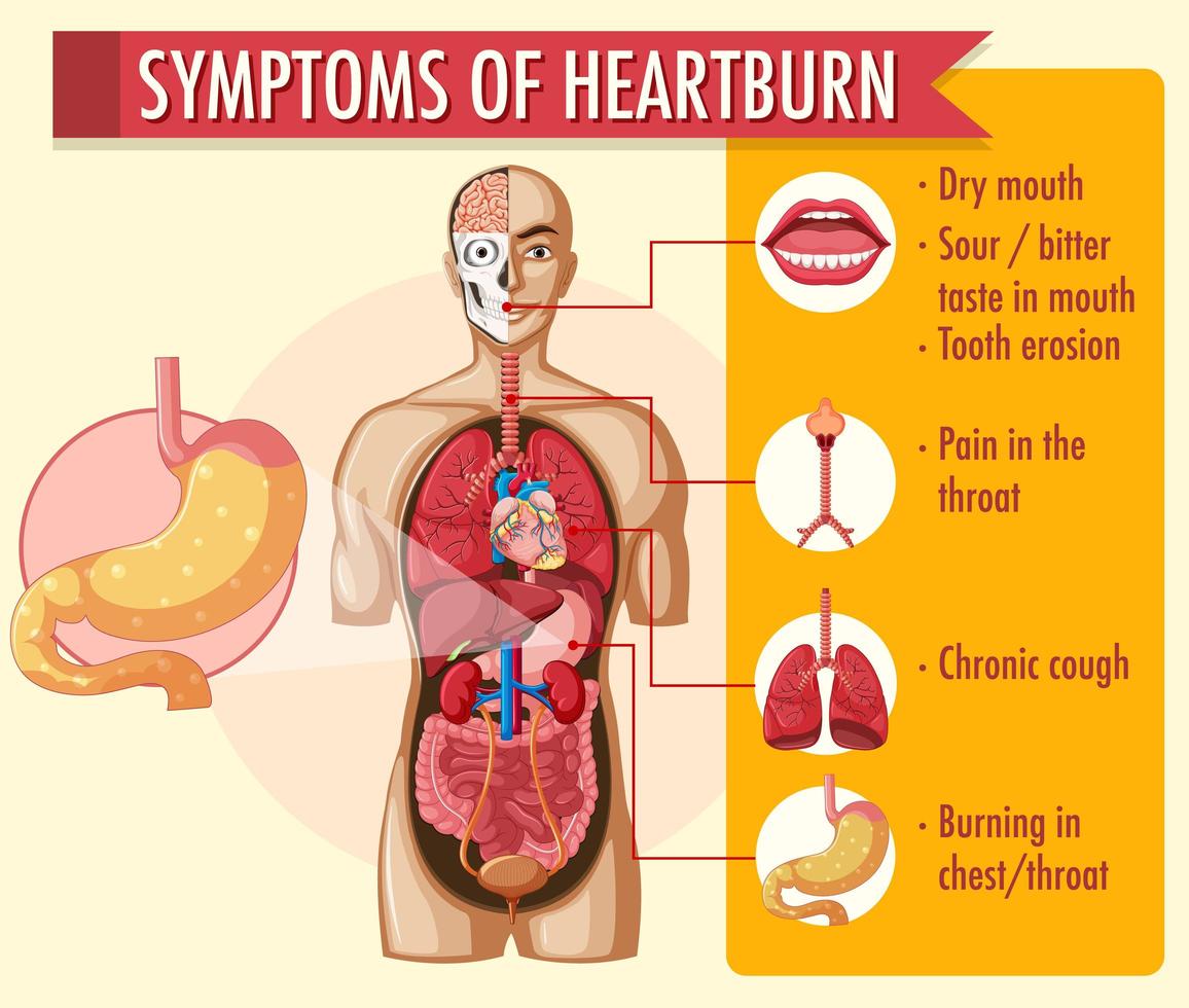 Symptoms of heartburn infographic vector