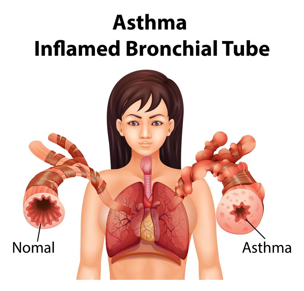 tubo bronquial inflamado por asma vector