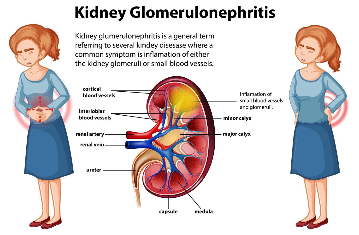 Medical infographic of kidney glomerulosclerosis vector