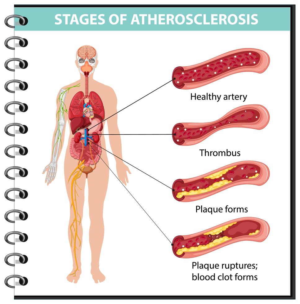 etapas de la aterosclerosis infografía. vector