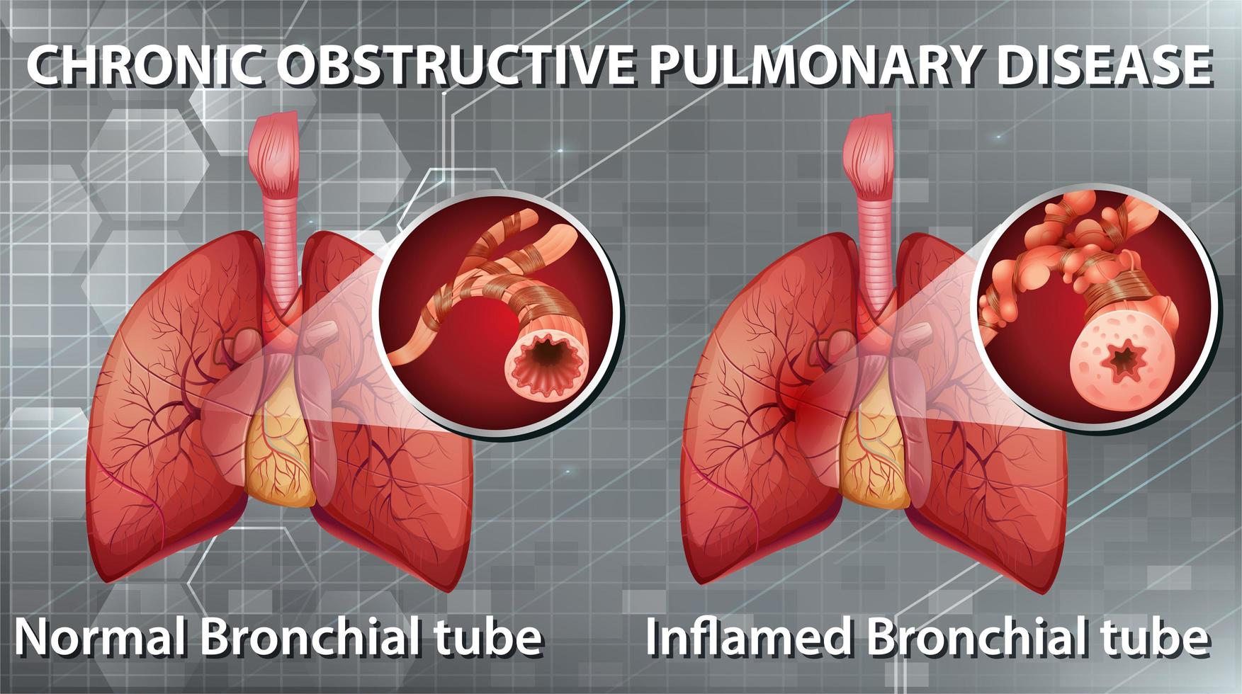 tabla de enfermedad pulmonar obstructiva crónica vector