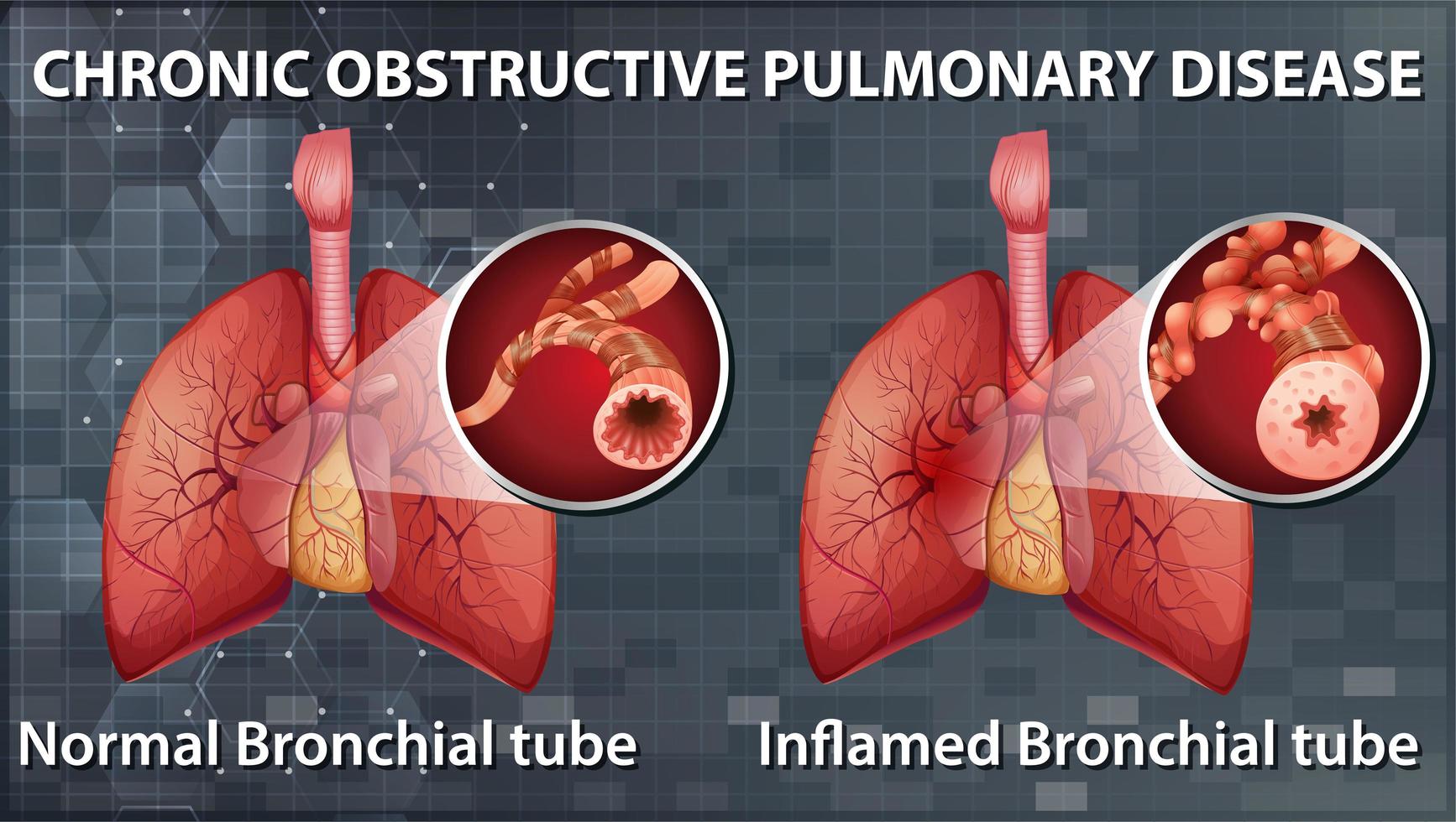 enfermedad pulmonar obstructiva crónica vector