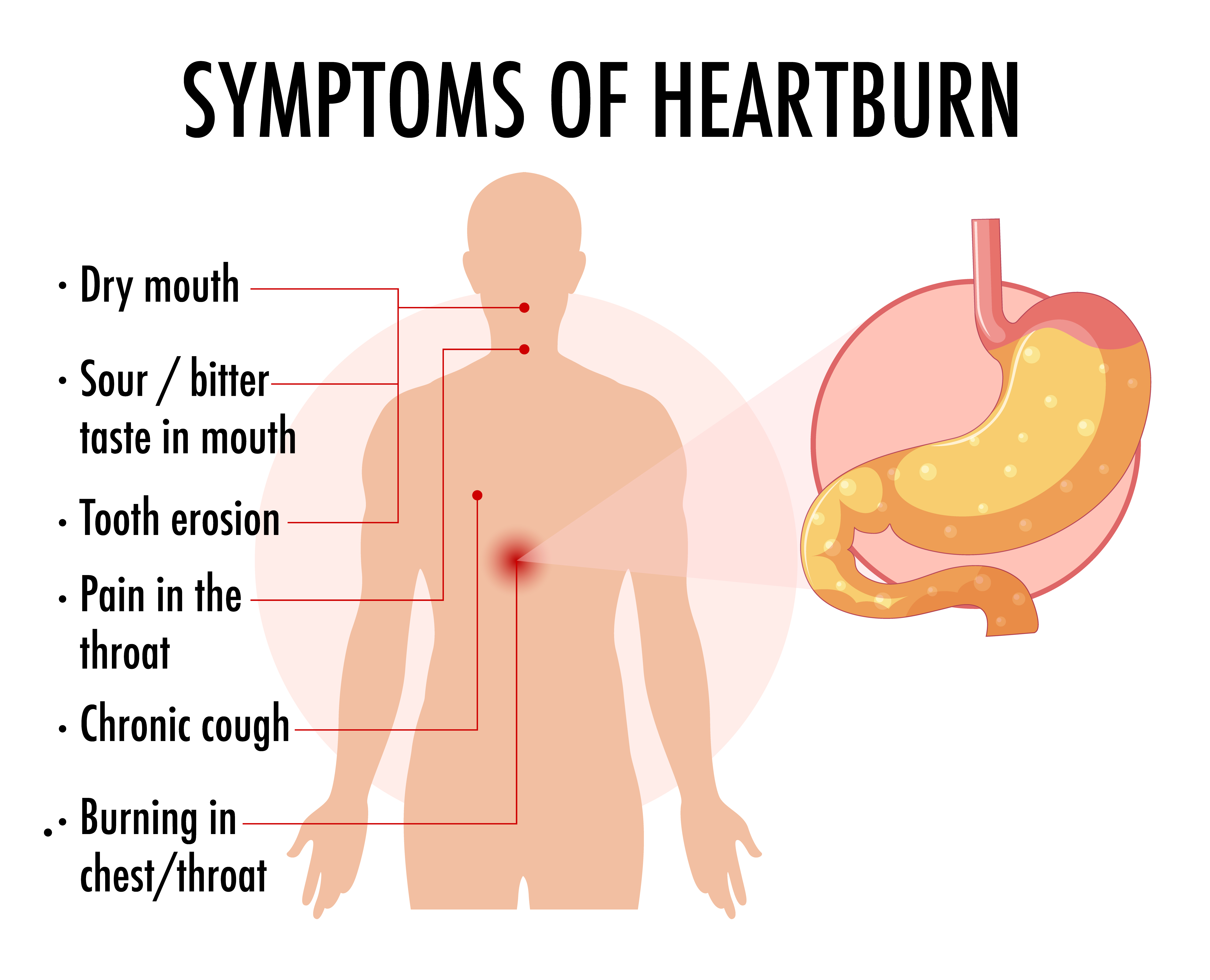 Heartburn symptom