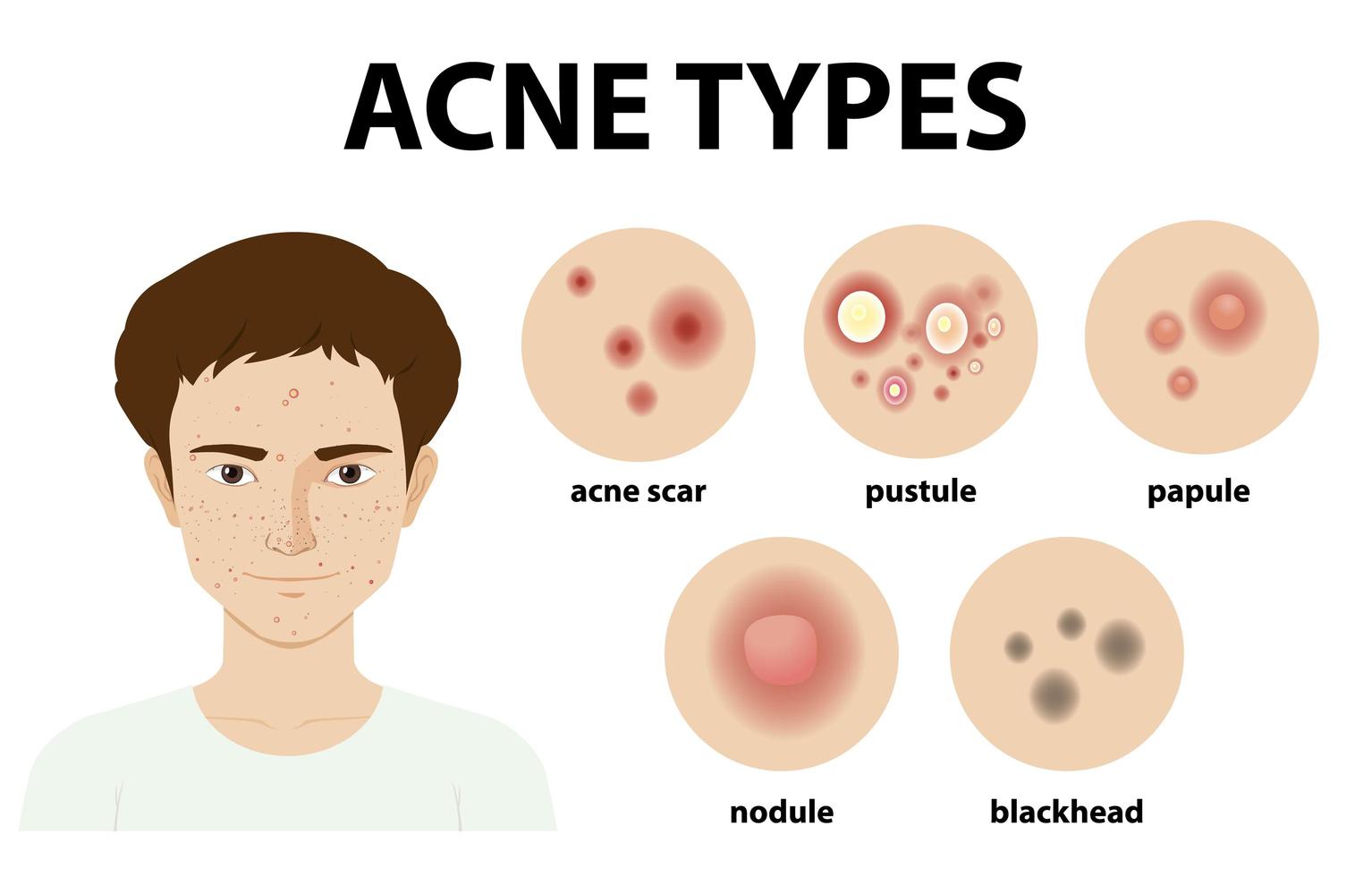 Acné : les différents types de boutons - The Good Balance