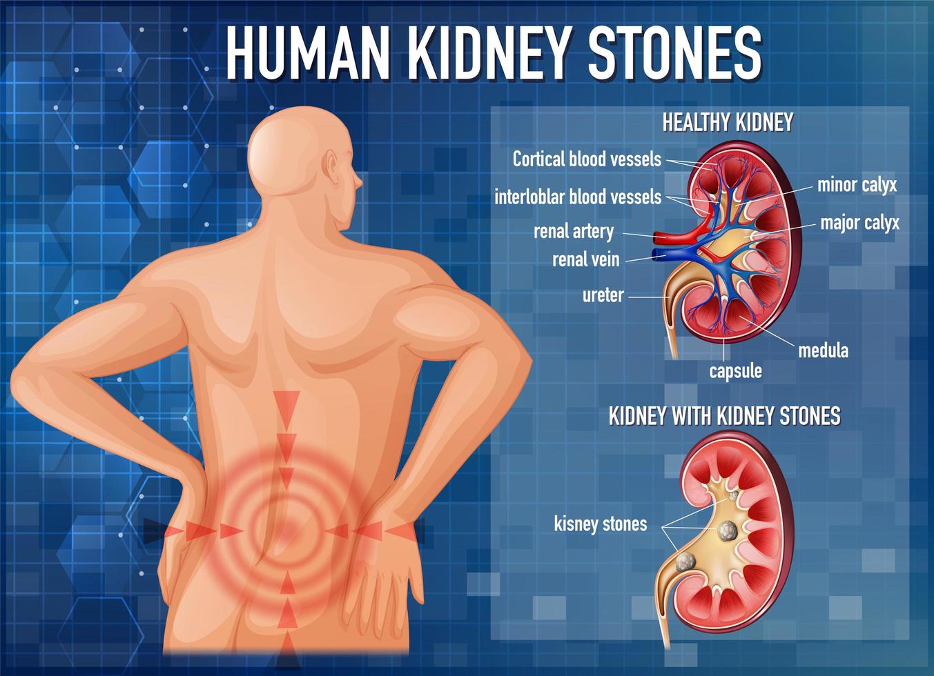 Comparison of healthy kidney and kidney with stones vector