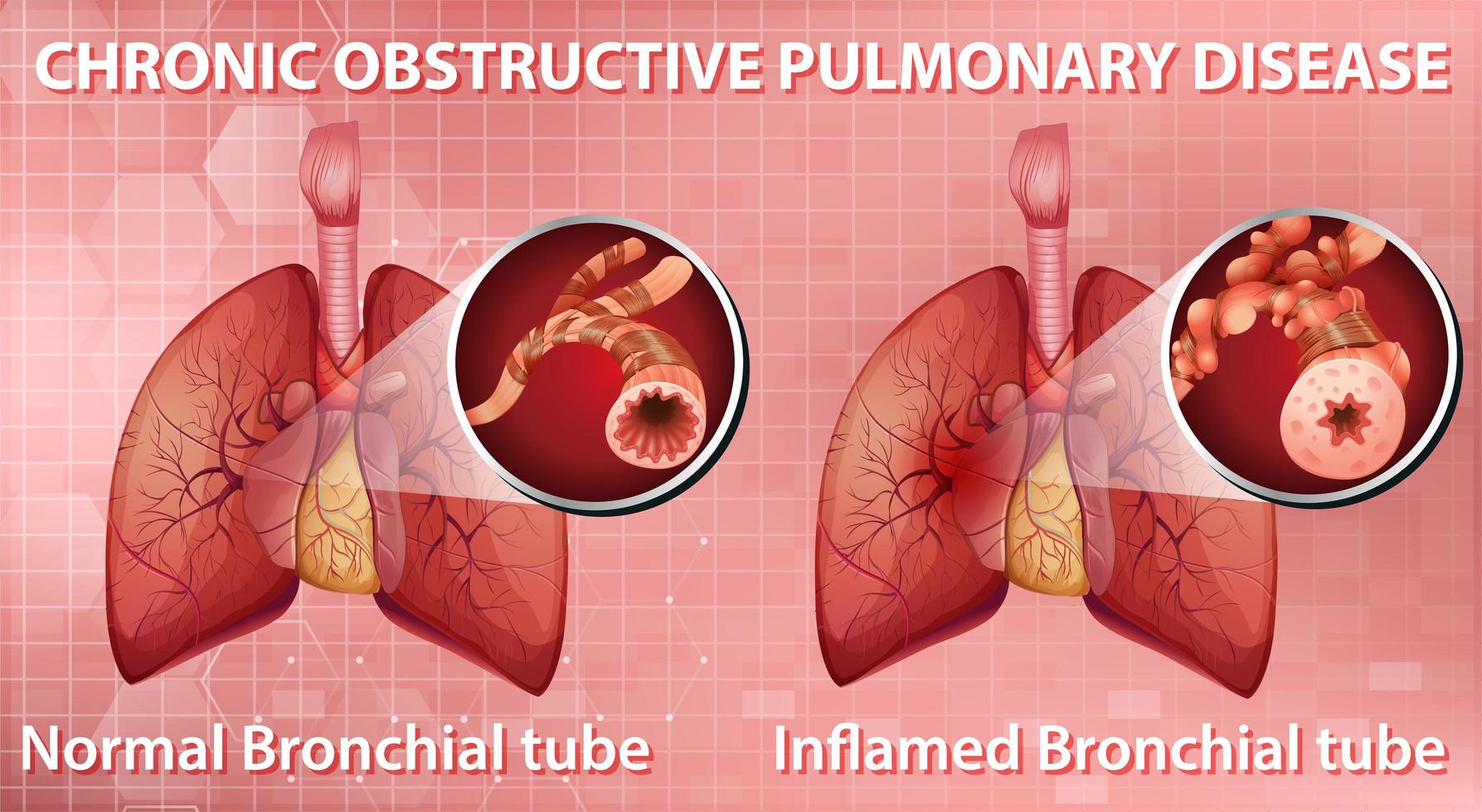 enfermedad pulmonar obstructiva crónica vector