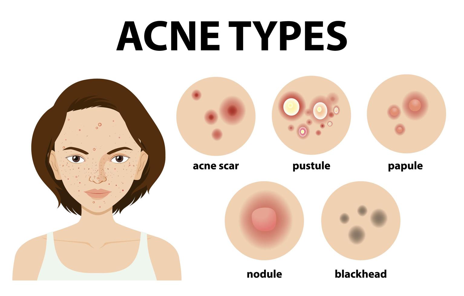 Types of acne on the skin or pimples vector