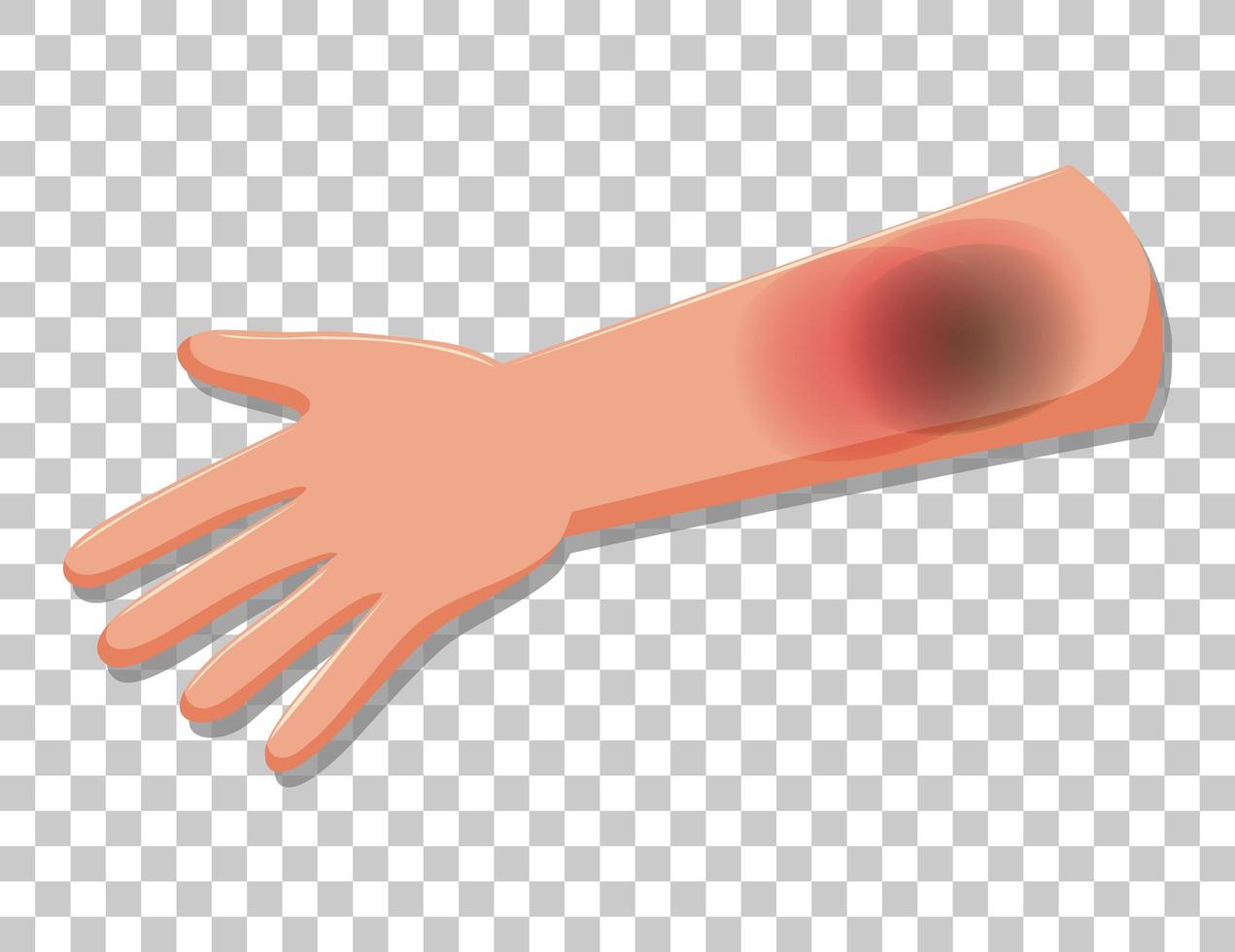 Bruised skin on an arm isolated on transparent background vector