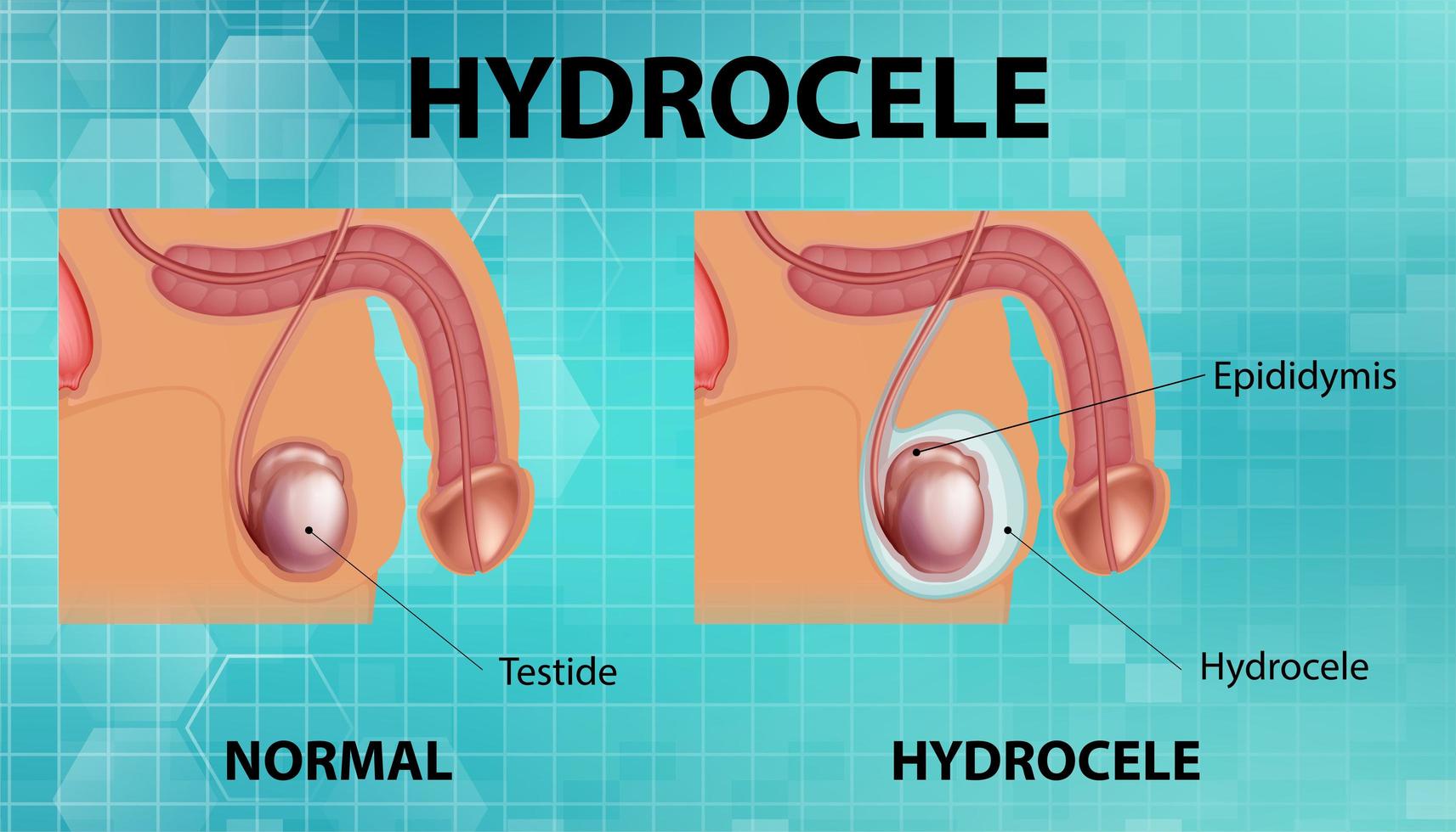 Póster médico que muestra diferencias entre el testículo masculino normal y el hidrocele. vector