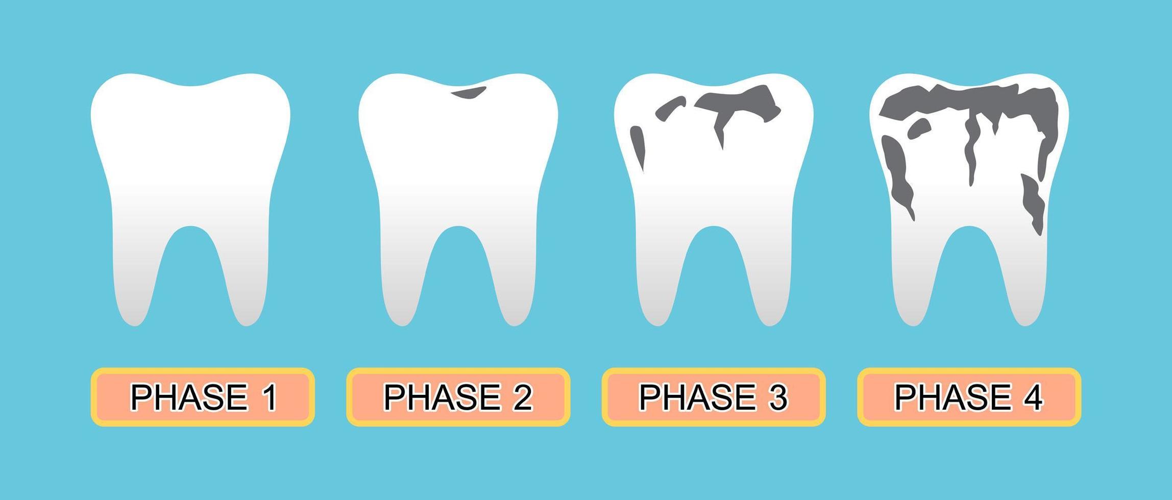 Tooth caries and Stage of the disease. vector