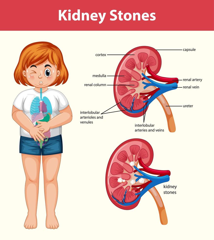 infografía de estilo de dibujos animados de cálculos renales humanos vector