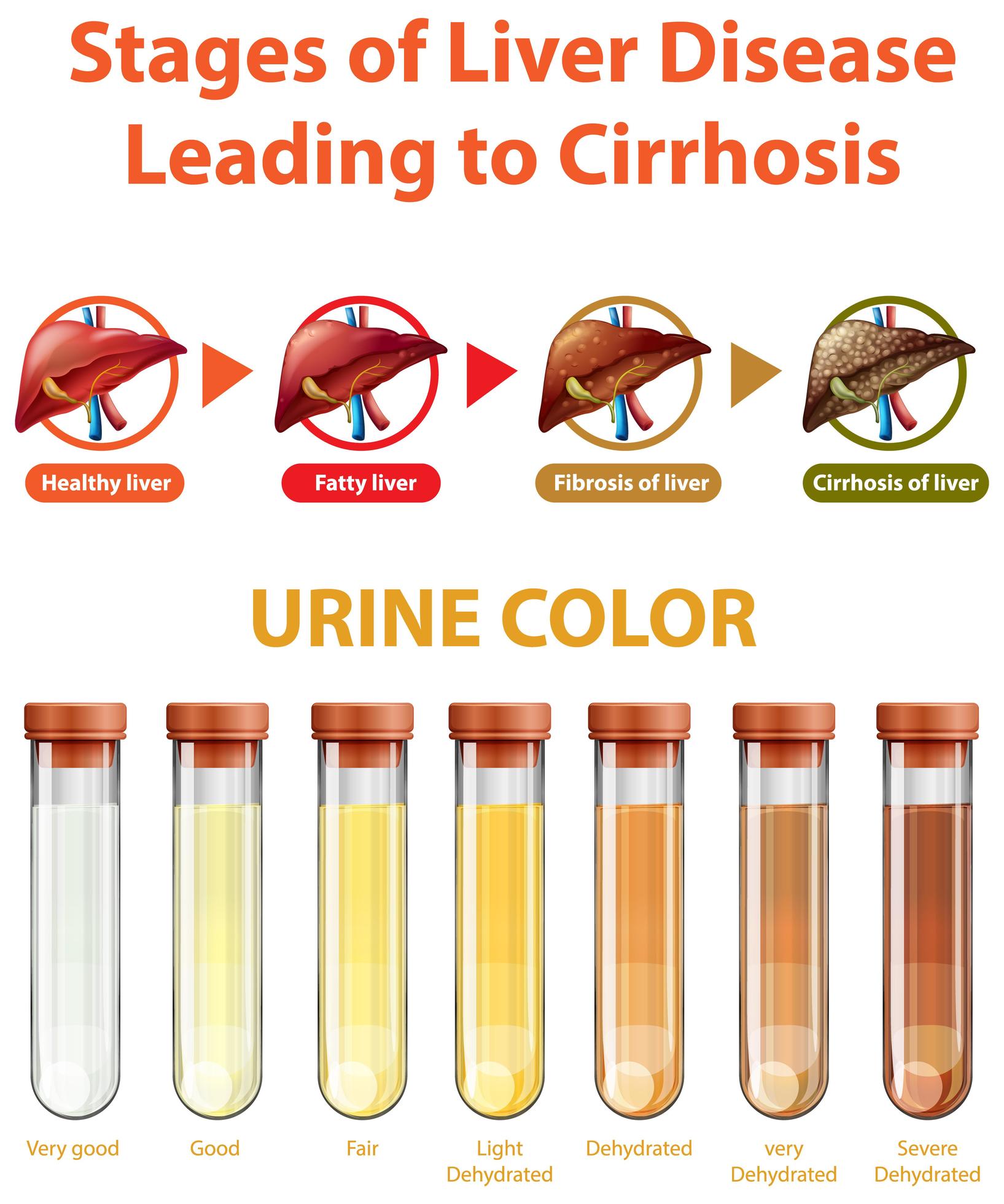 Stages of liver disease leading to Cirrhosis 1778152 Vector Art at Vecteezy
