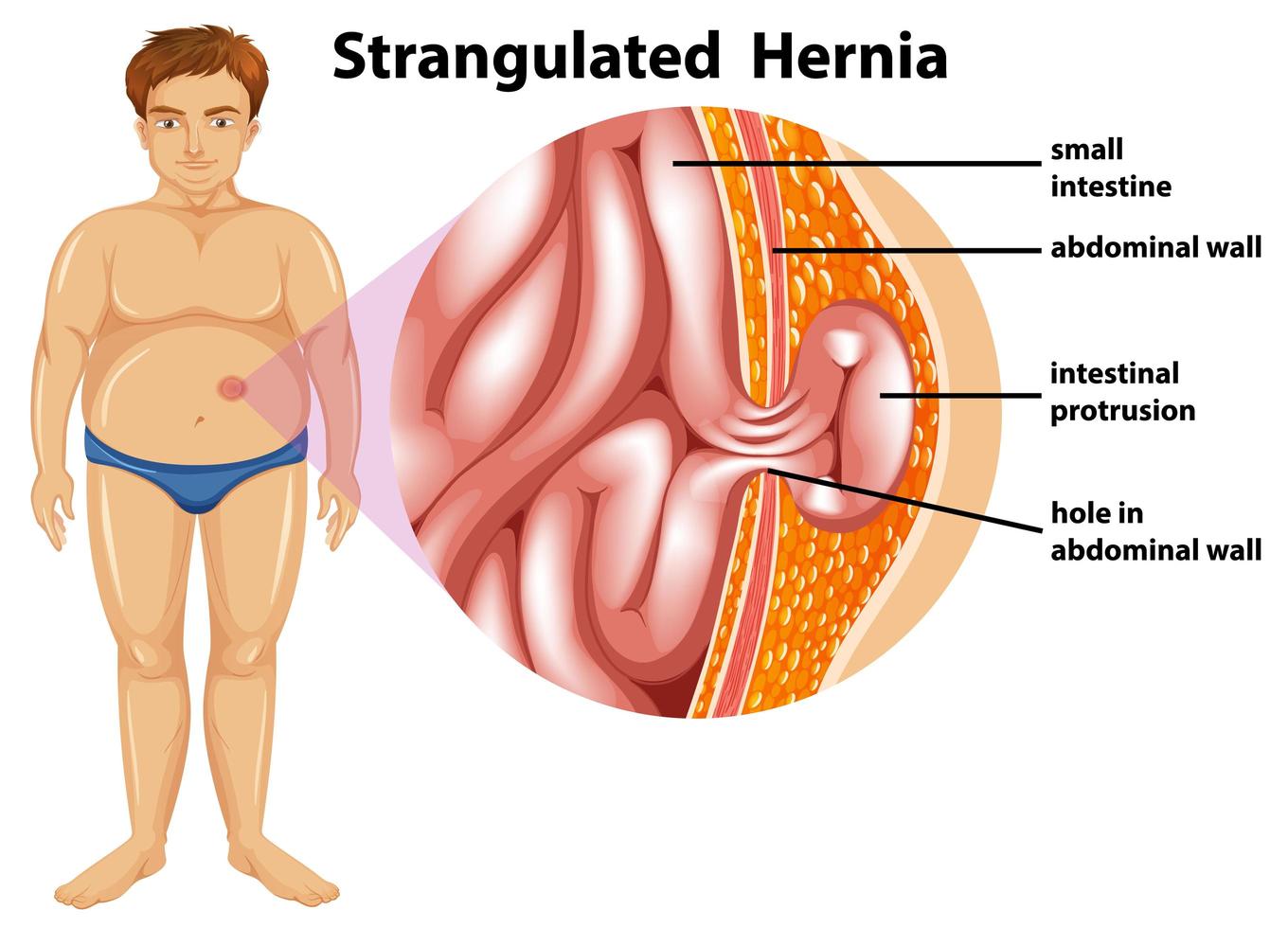 Man Strangulated Hernia Diagram vector