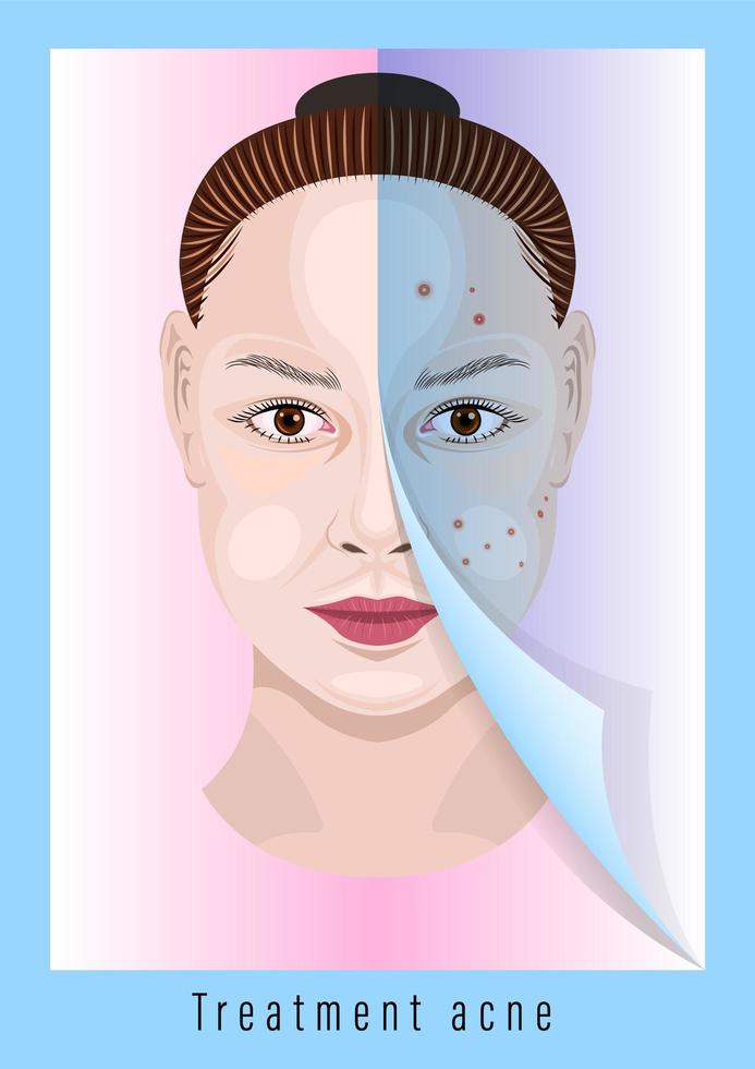 Woman Face Before and After Acne Treatment vector