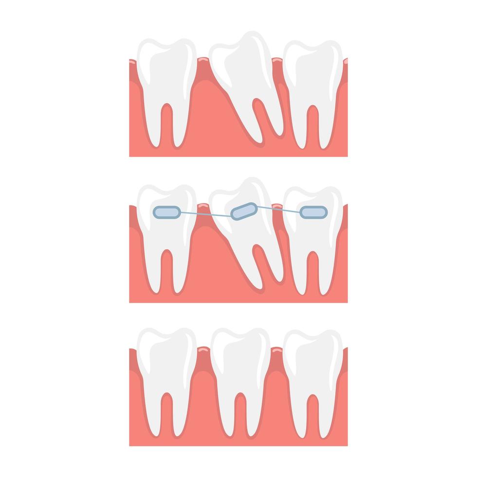 Braces vector design illustration isolated on white background