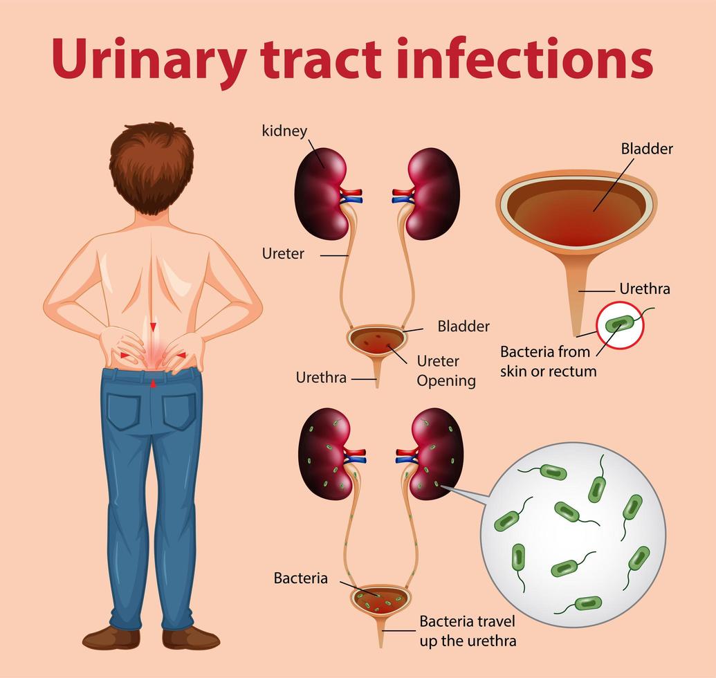 Ilustración informativa de infecciones del tracto urinario. vector