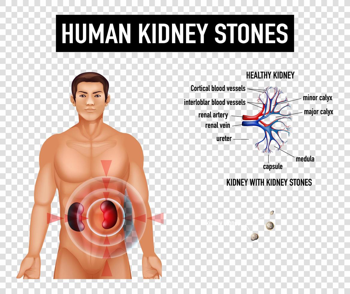 diagrama que muestra cálculos renales humanos vector