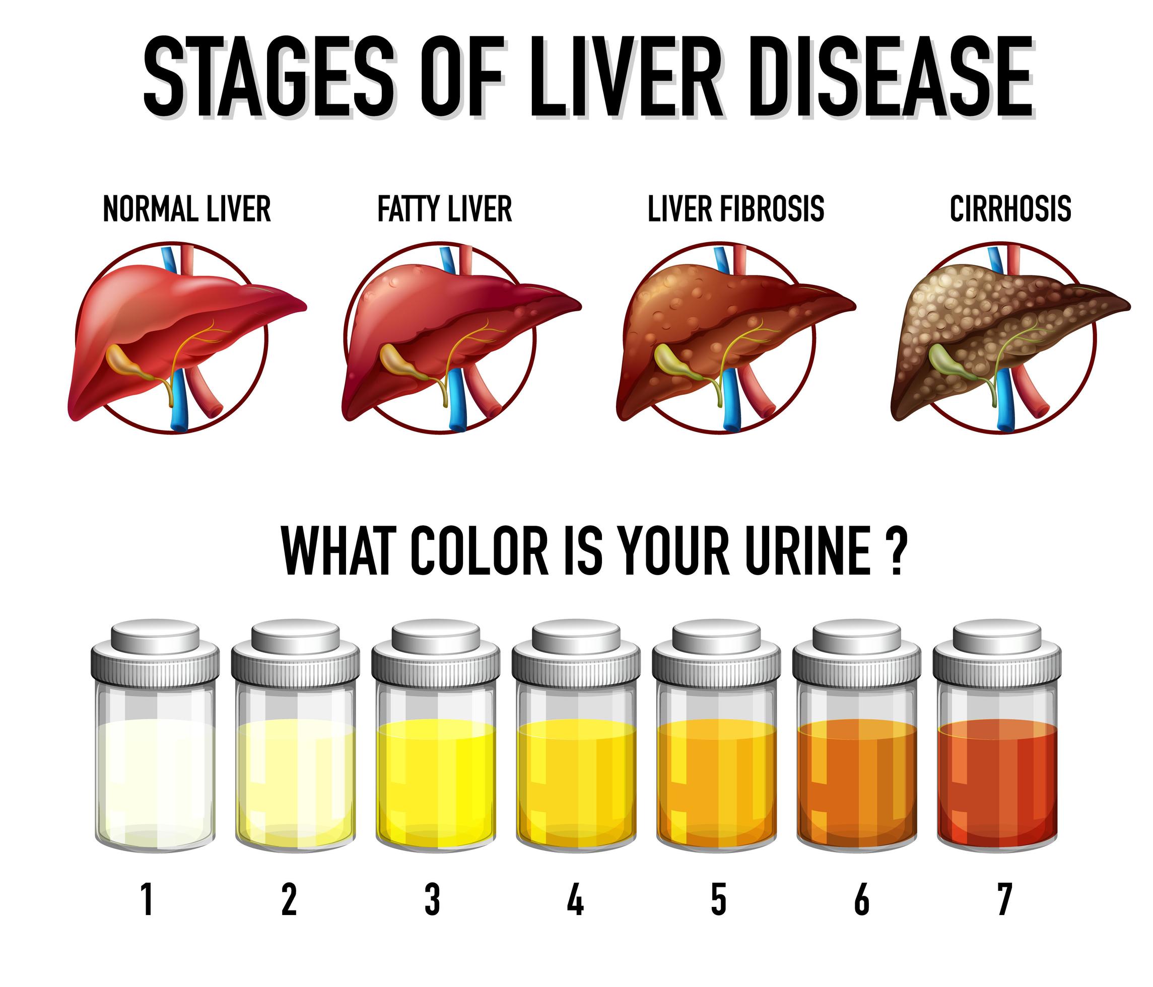 Liver Disease Vector Infographics Sign And Symptoms Of Liver Disease ...