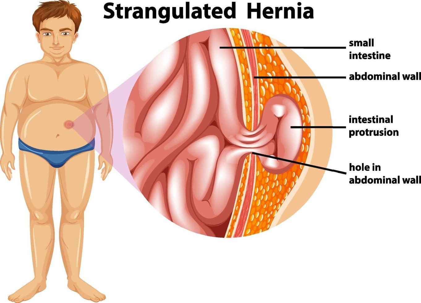 Man with strangulated hernia vector